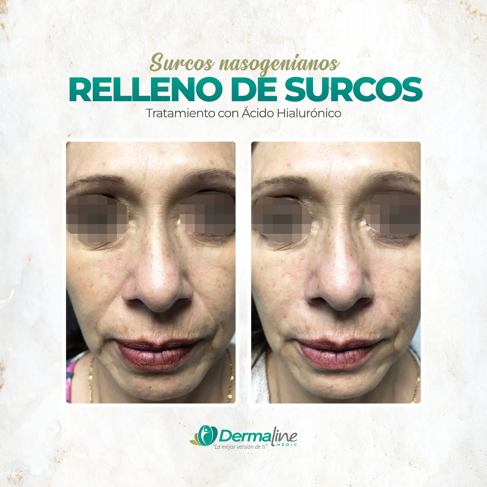 Post-Relleno-de-Surcos