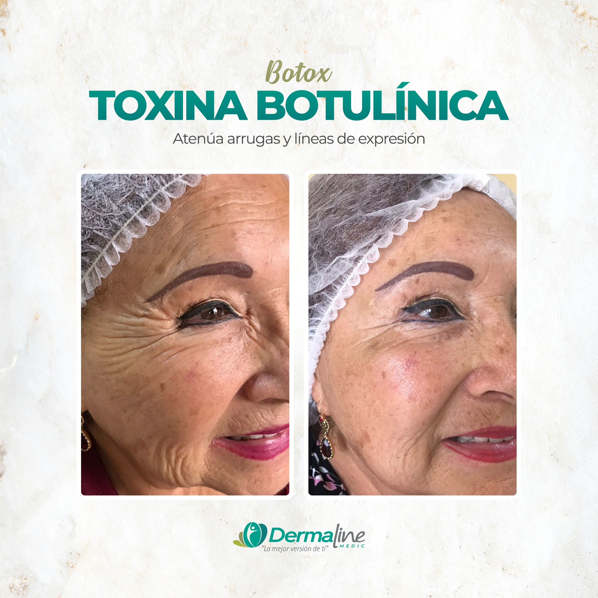 Toxina-Botulínica
